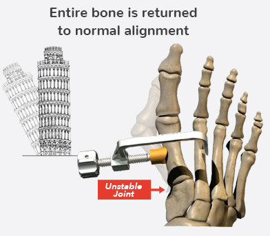 Entire bone is returned to normal alignment Graphic