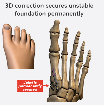 3D correction secures unstable foundation permanently Graphic