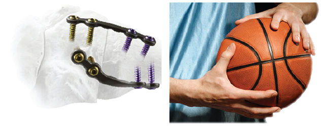 Surgical plates - Hands holding a basketball