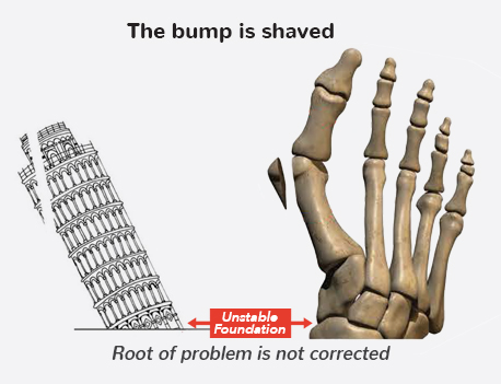 The Bump is Shaved Graphic