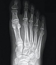 Normal Foot X-Ray
