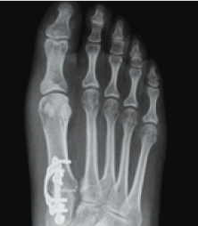 Lapiplasty® 3D Bunion Correction™ X-Ray